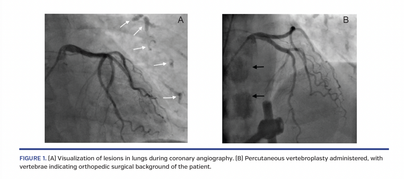 Late Manifestation of Pulmonary Cement Embolism Visualized by Coronary